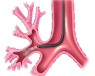 Nefes Darlığı Tedavisi
